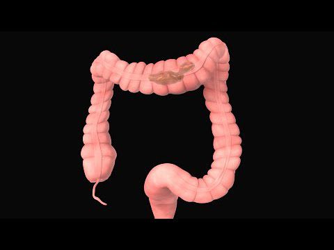 Sindrome-del-intestino-irritable - i-Healthcare
