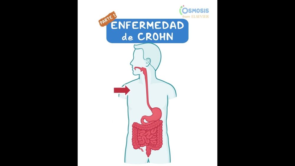 enfermedad-de-crohn - i-Healthcare