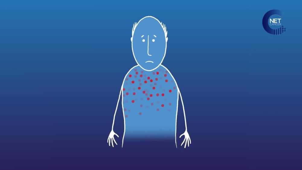 Ipilimumab - i-Healthcare
