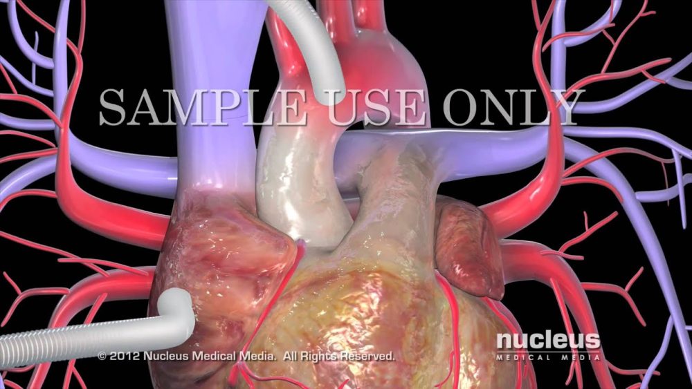 Cirugia-Cardiovascular-Avances-en-Procedimientos-Quirurgicos-y-Tecnologias - i-Healthcare