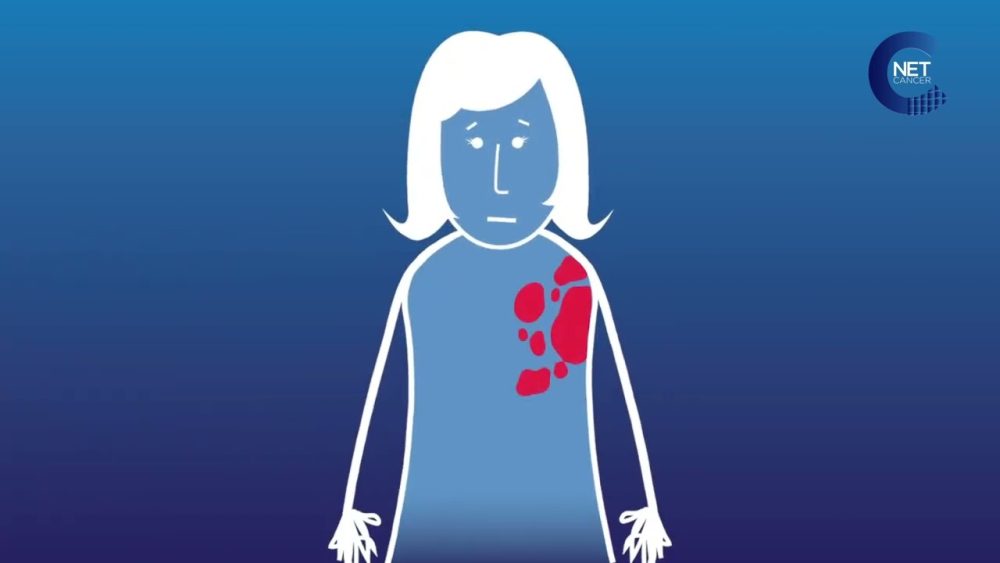 Trastuzumab - i-Healthcare