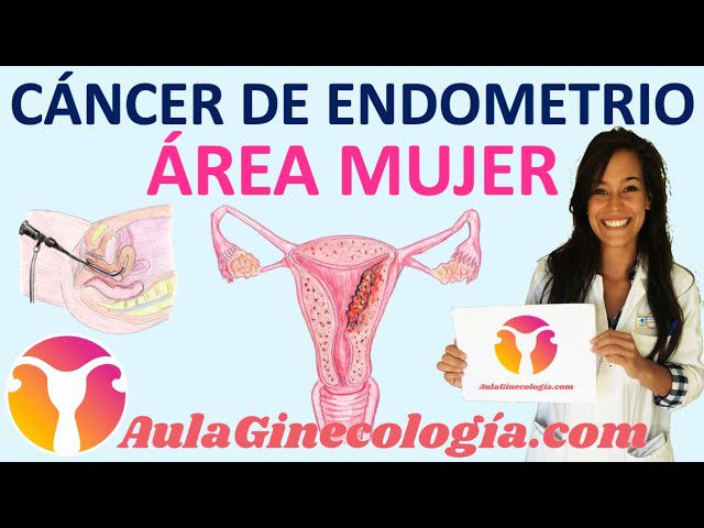Cómo identificar y tratar el cáncer de endometrio