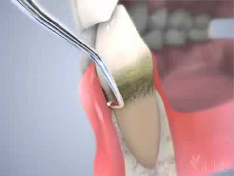 Dentista-en-Capolat - i-Healthcare Dentista en Capolat