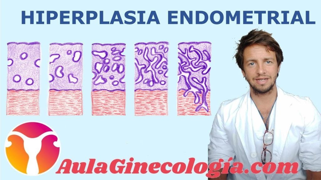 Cómo manejar la hiperplasia endometrial