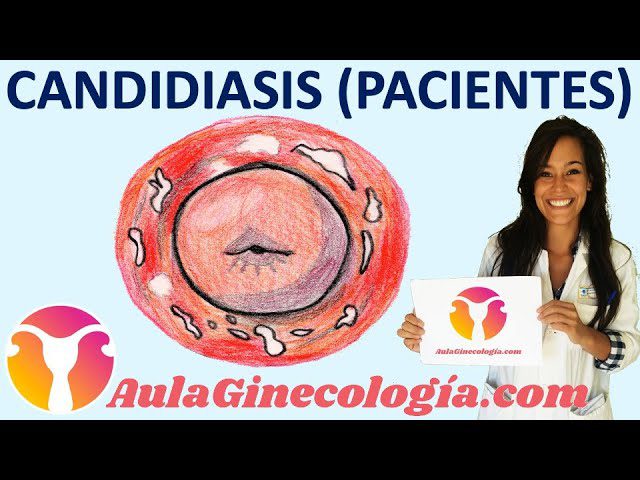 Cómo prevenir y tratar la candidiasis vaginal recurrente