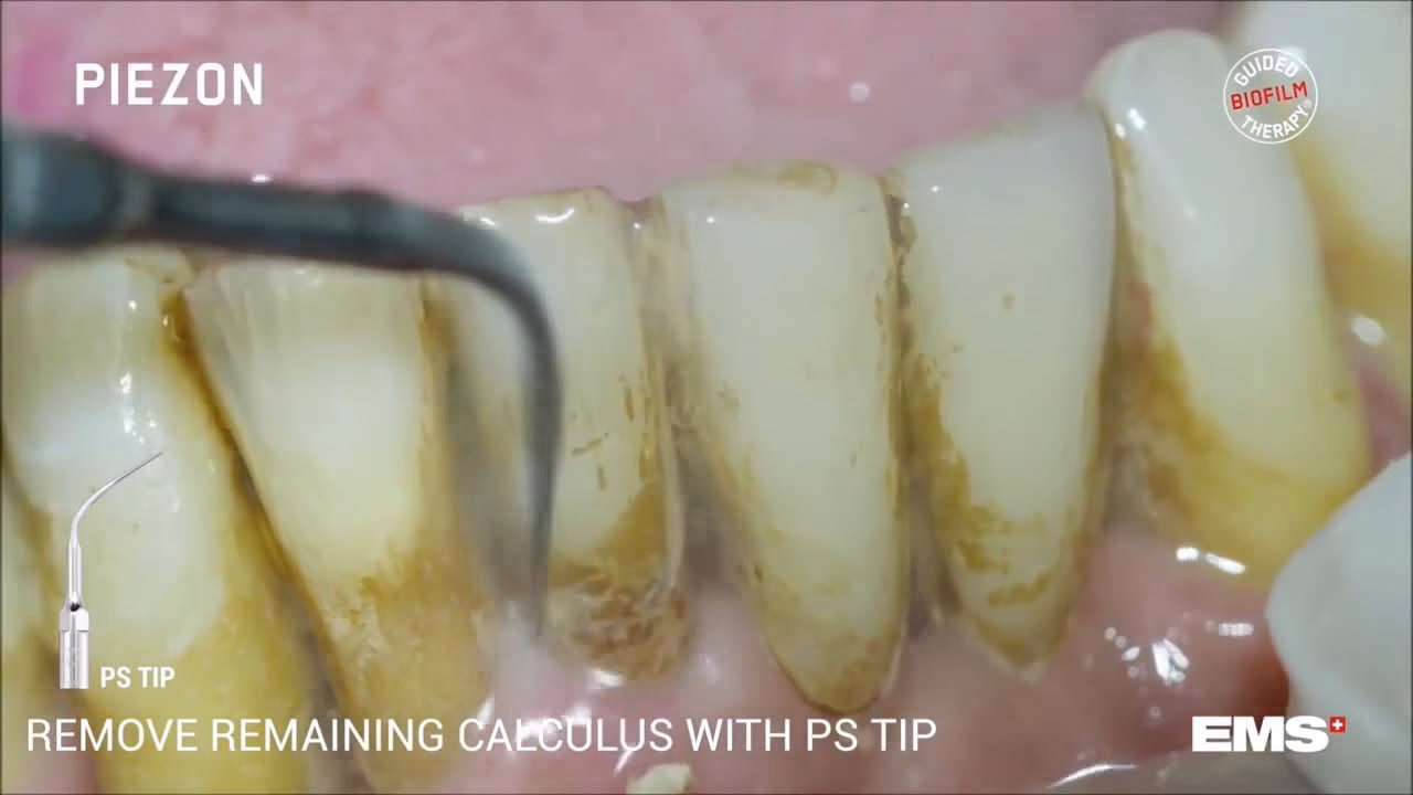 Dentista en  Tavertet