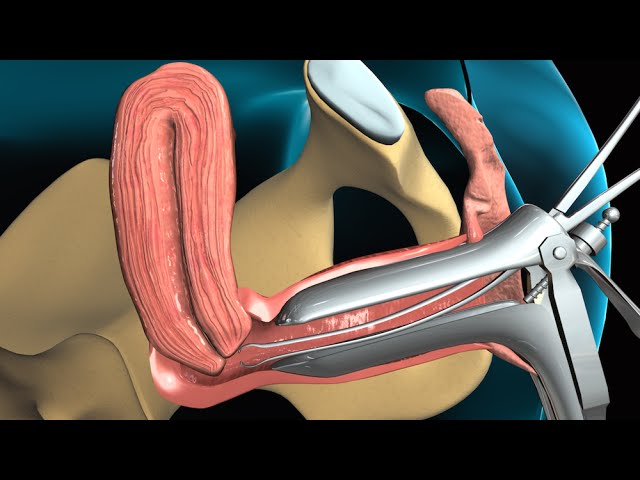 Todo lo que necesitas saber sobre la biopsia endometrial