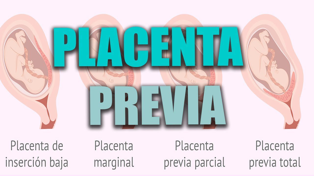 Todo-sobre-el-seguimiento-del-embarazo-con-placenta-previa - i-Healthcare Todo sobre el seguimiento del embarazo con placenta previa
