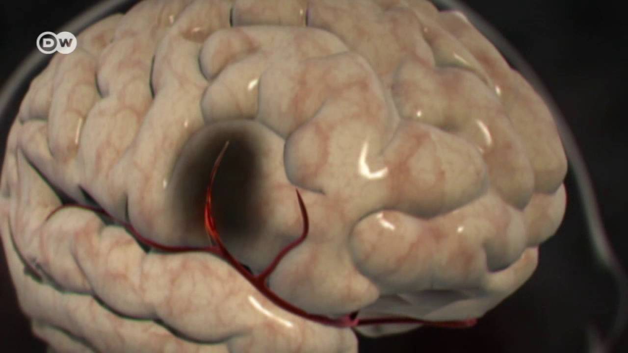 Como-el-accidente-cerebrovascular-ha-cambiado-la-vida-de-personalidades-hispanas - i-Healthcare Cómo el accidente cerebrovascular ha cambiado la vida de personalidades hispanas