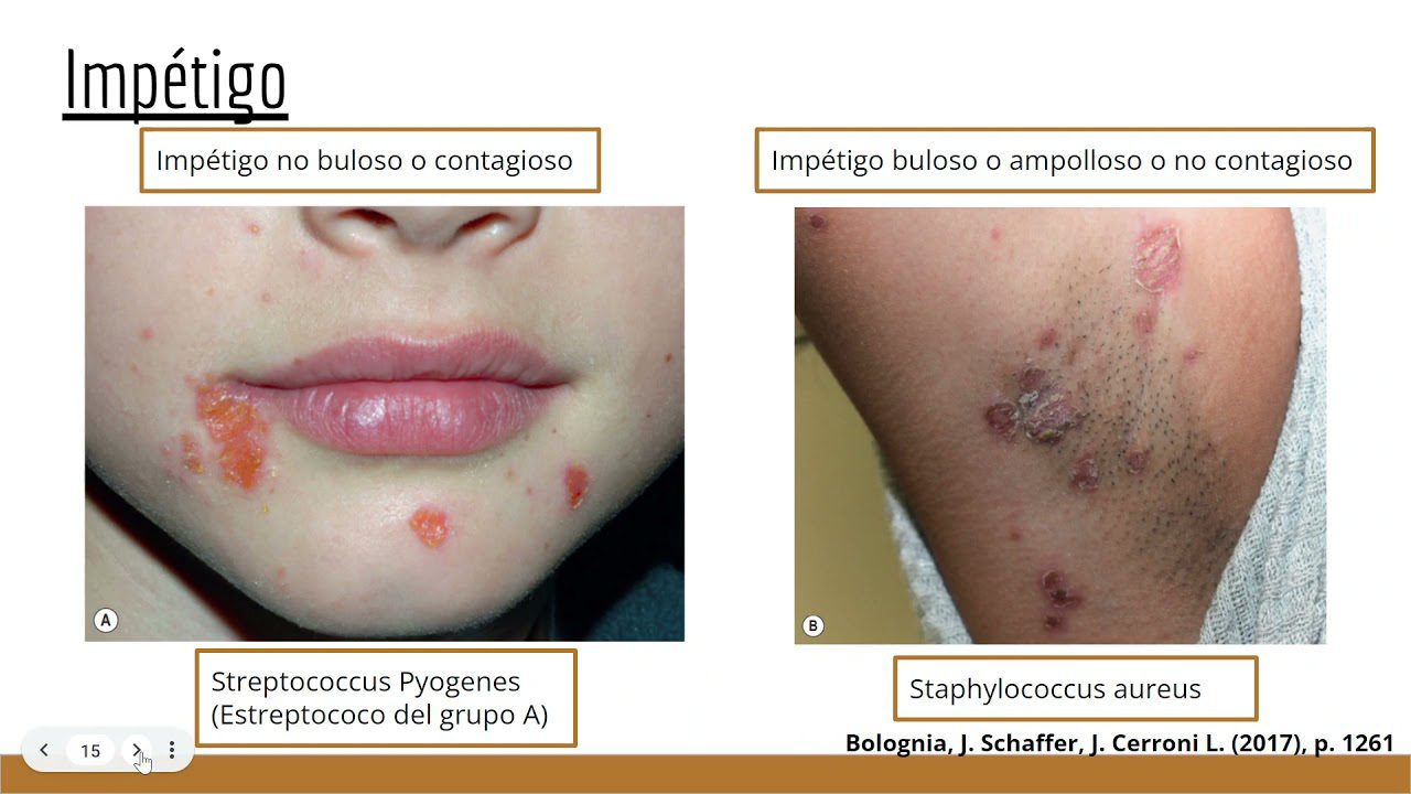 Cómo las enfermedades de la piel han afectado a figuras públicas hispanas