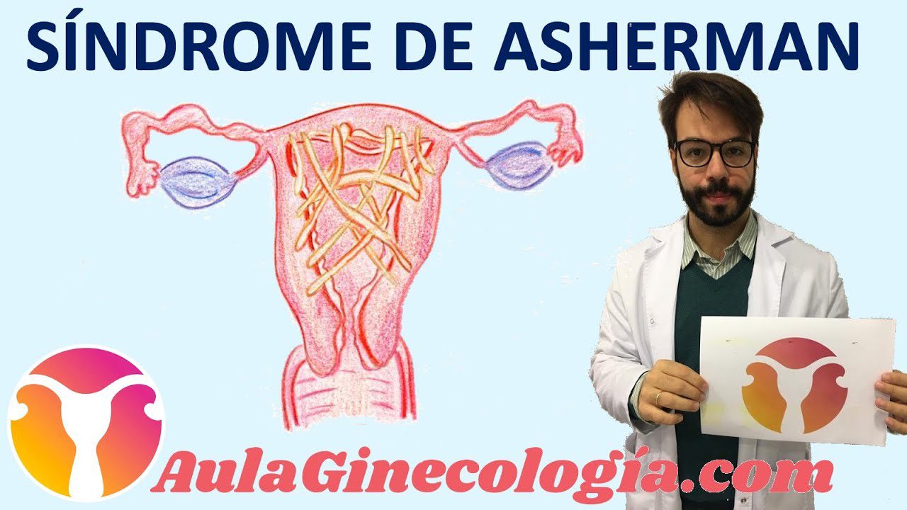Como-manejar-el-sindrome-de-Asherman - i-Healthcare Cómo manejar el síndrome de Asherman
