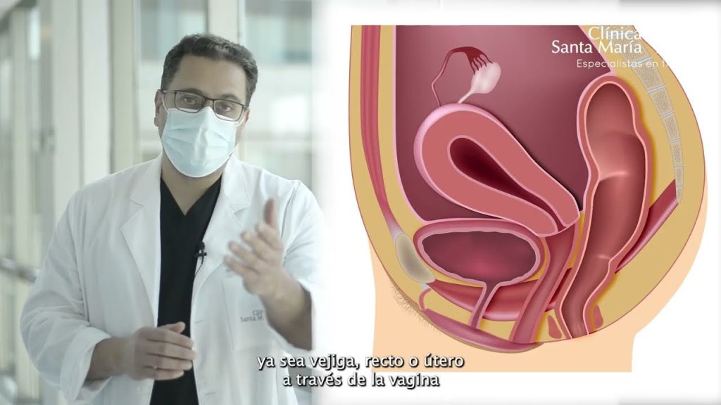 Todo sobre los tratamientos para el prolapso uterino