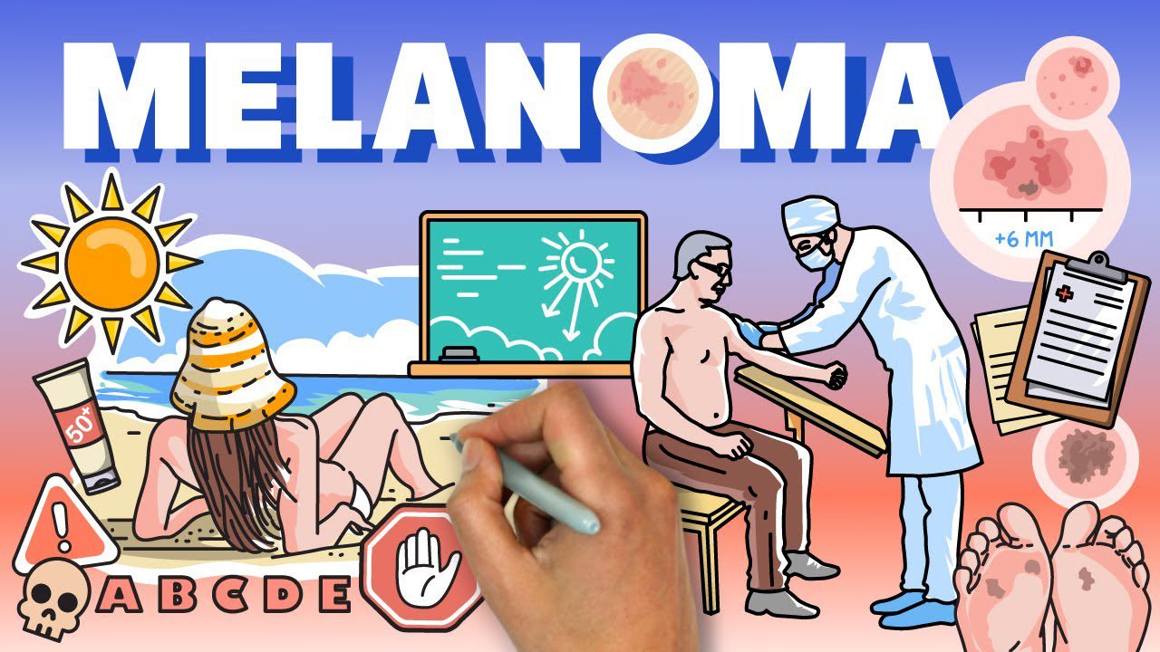 El impacto del melanoma en figuras icónicas de la música y el cine hispano