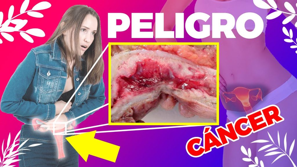 Todo lo que necesitas saber sobre la hiperplasia benigna del endometrio