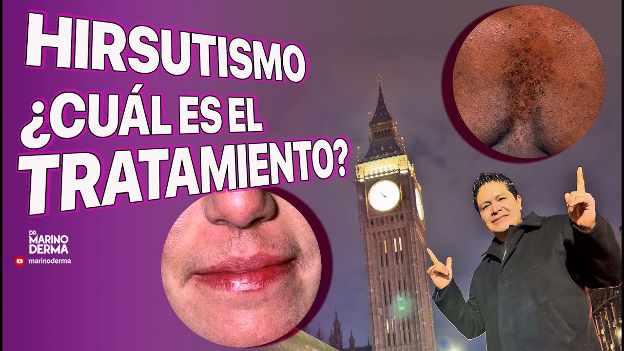 Todo-sobre-los-tratamientos-para-el-hirsutismo - i-Healthcare Todo sobre los tratamientos para el hirsutismo