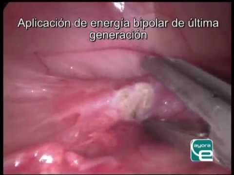 Como-manejar-el-sindrome-de-ovario-remanente - i-Healthcare Cómo manejar el síndrome de ovario remanente