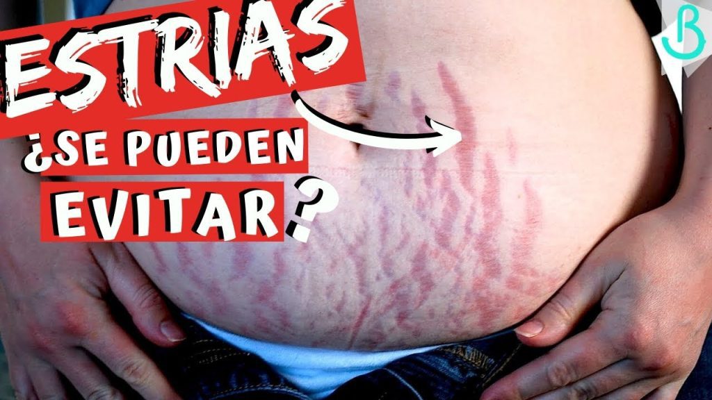 Cómo prevenir las estrías durante el embarazo