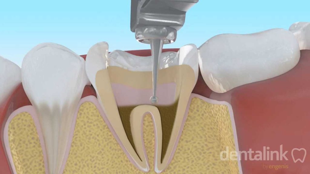 Dentista en  Abertura