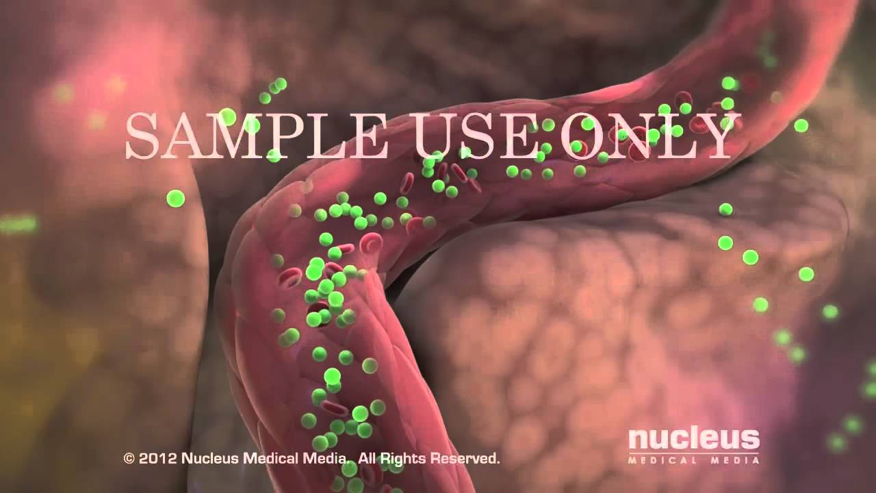 Cómo manejar el síndrome de ovario luteinizado crónico