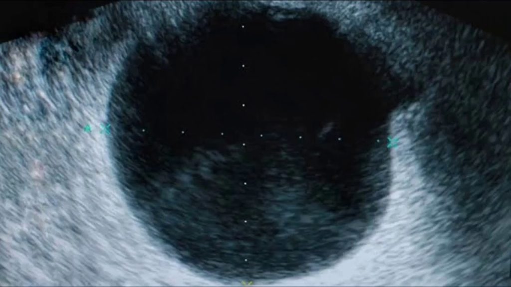 Cómo manejar el síndrome de ovario luteinizado complejo