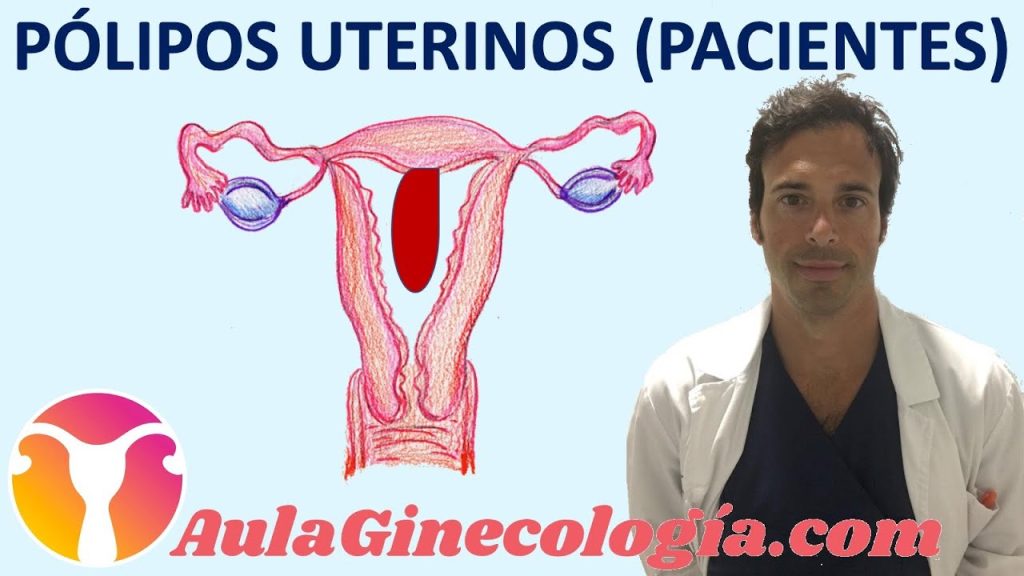 Todo lo que necesitas saber sobre la extracción de pólipos cervicales