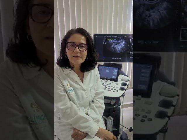 Cómo manejar el síndrome de ovario luteinizado transitorio