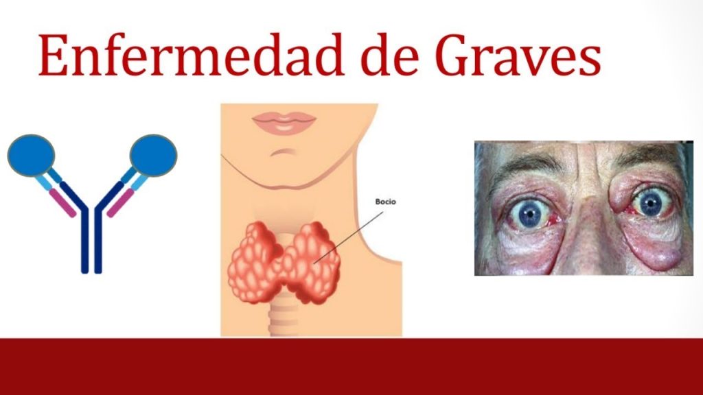 La relación entre la enfermedad de Graves y la salud ginecológica